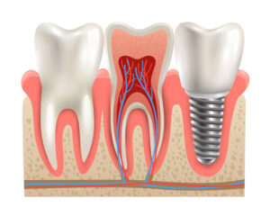 Tooth Bonding